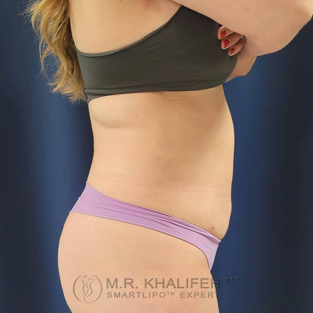 Abdominal Liposuction Gallery - Patient 122623079 - Image 6