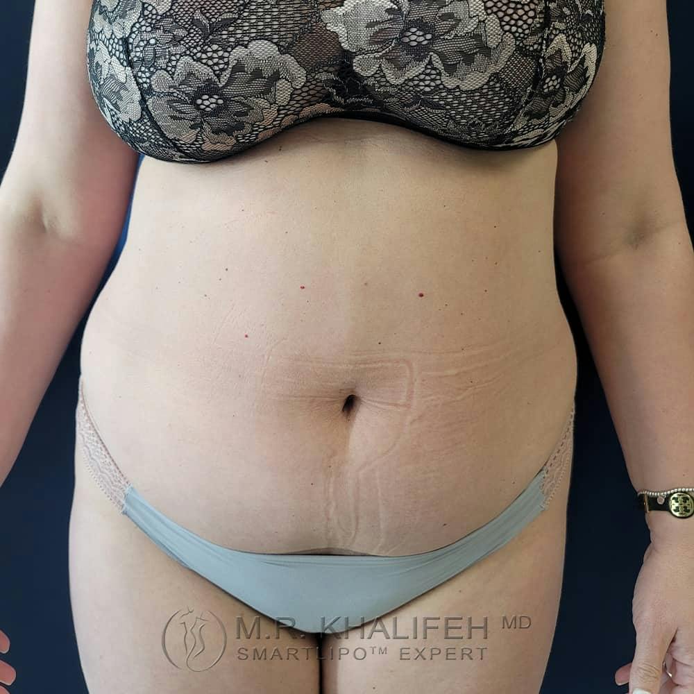 Abdominal Liposuction Gallery - Patient 122623079 - Image 1