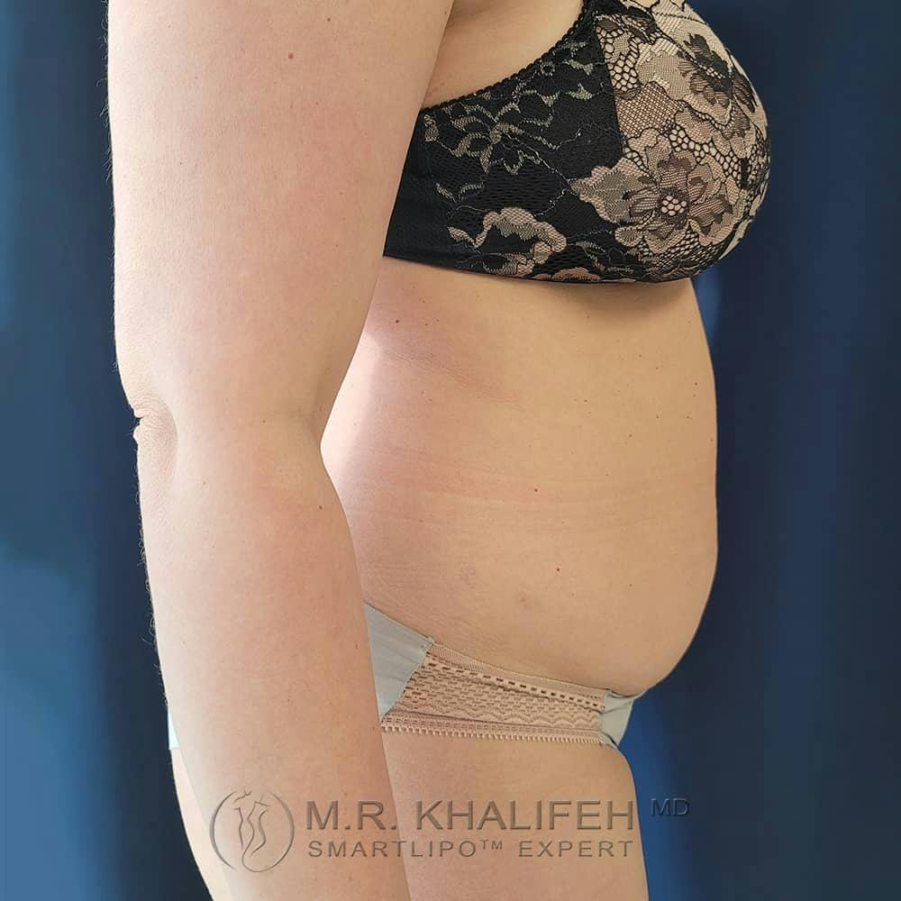 Abdominal Liposuction Gallery - Patient 122623079 - Image 5