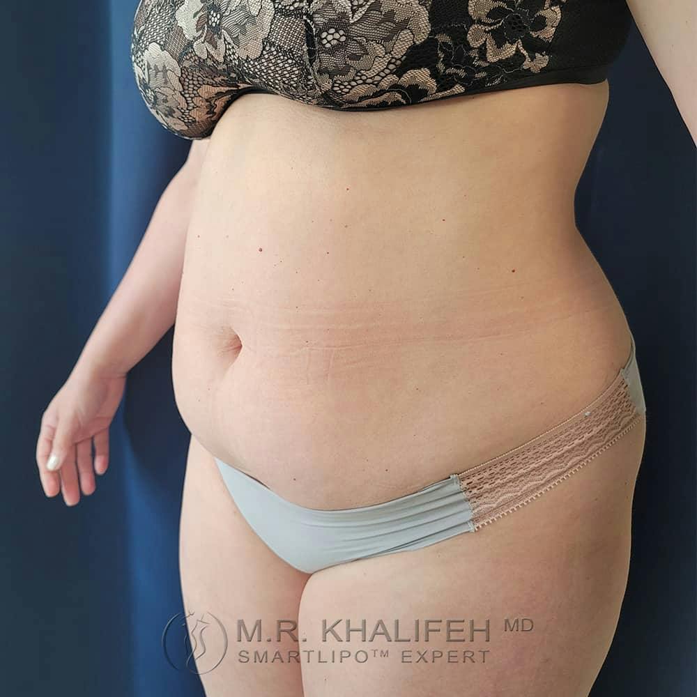 Abdominal Liposuction Gallery - Patient 122623079 - Image 7