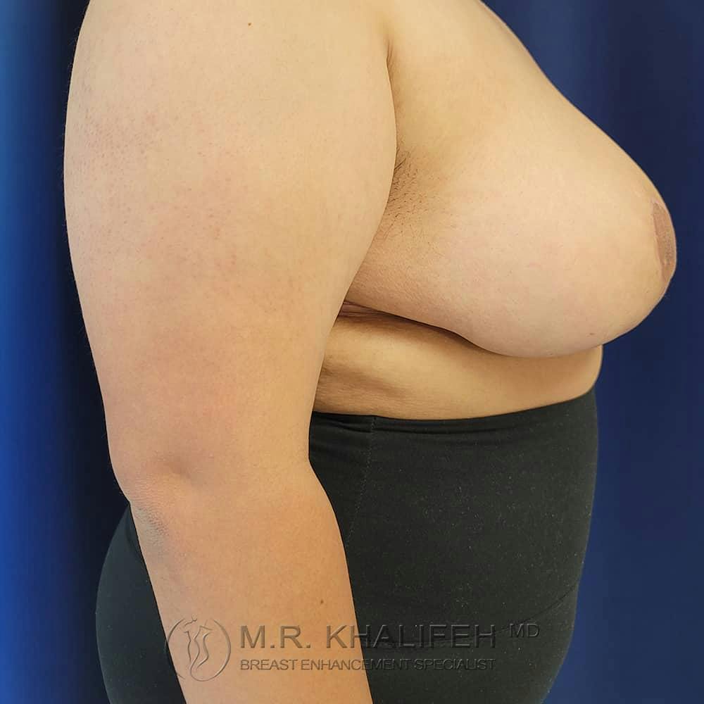 Breast Reduction Gallery - Patient 122623084 - Image 6