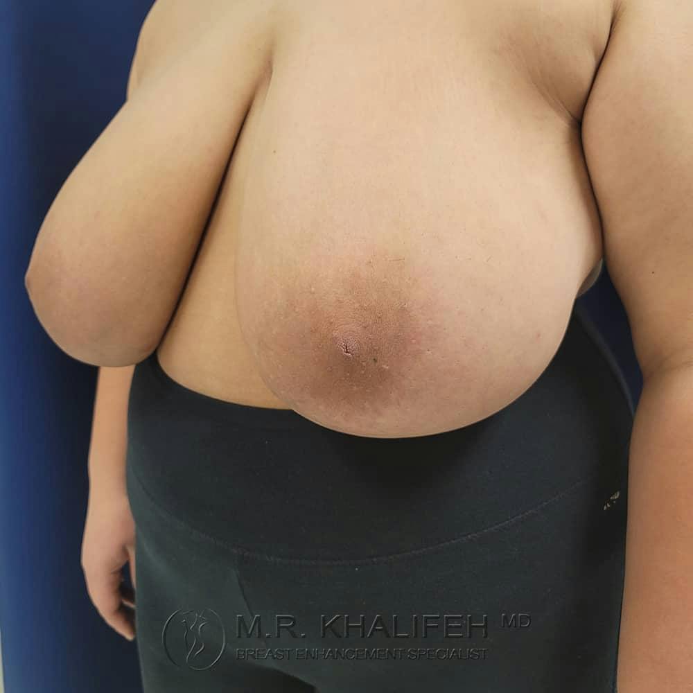 Breast Lift Gallery - Patient 122623083 - Image 7