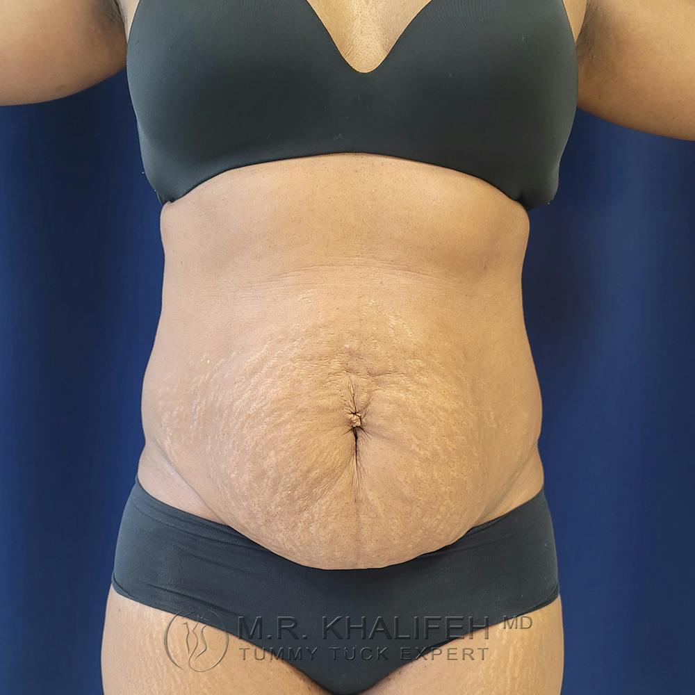 Tummy Tuck Gallery - Patient 122890613 - Image 1