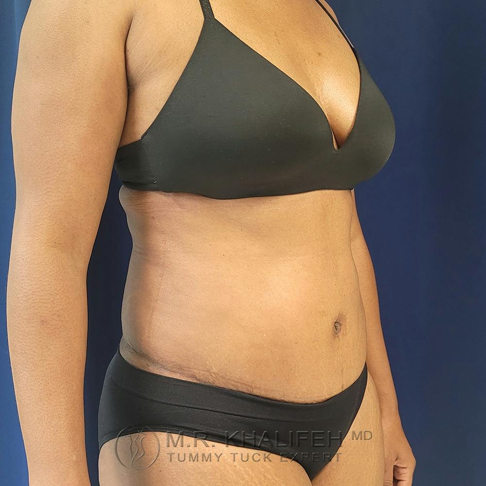 Tummy Tuck Gallery - Patient 122890613 - Image 4