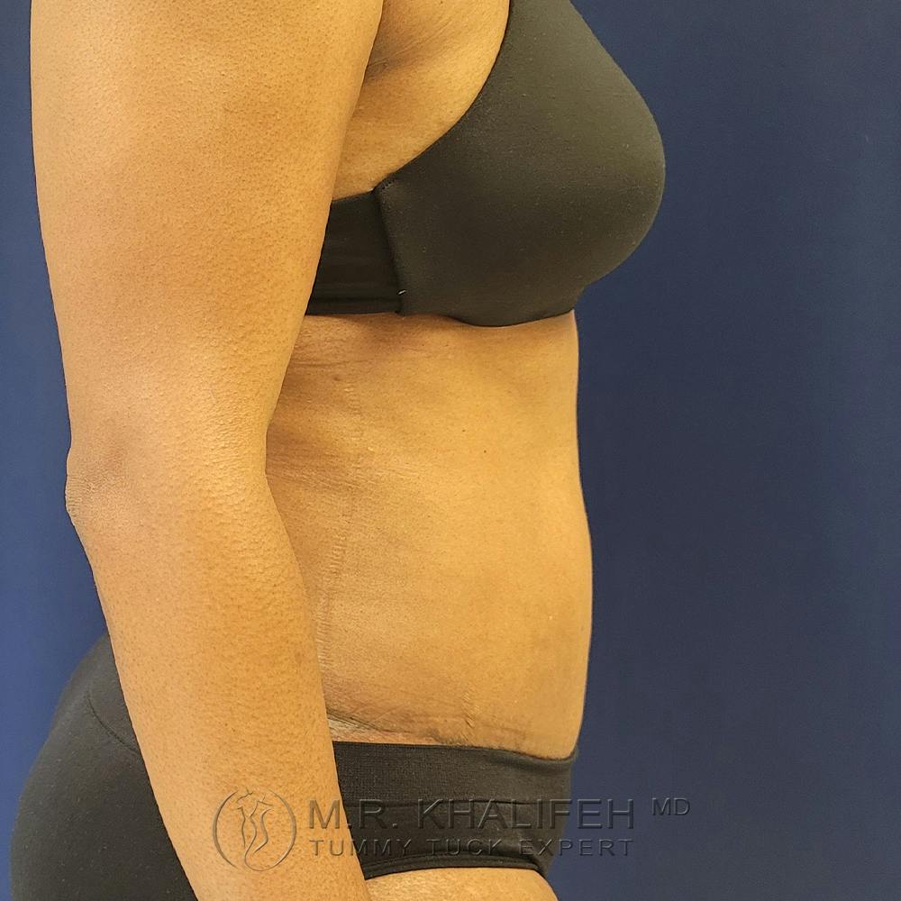 Tummy Tuck Gallery - Patient 122890613 - Image 6