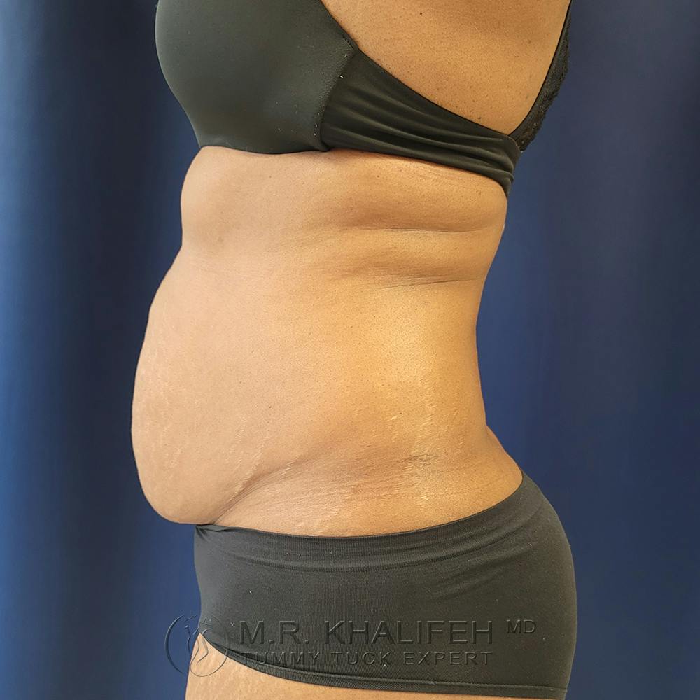 Tummy Tuck Gallery - Patient 122890613 - Image 7