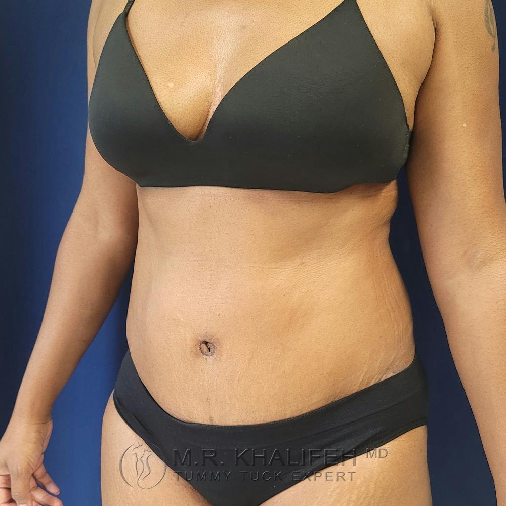 Tummy Tuck Gallery - Patient 122890613 - Image 10