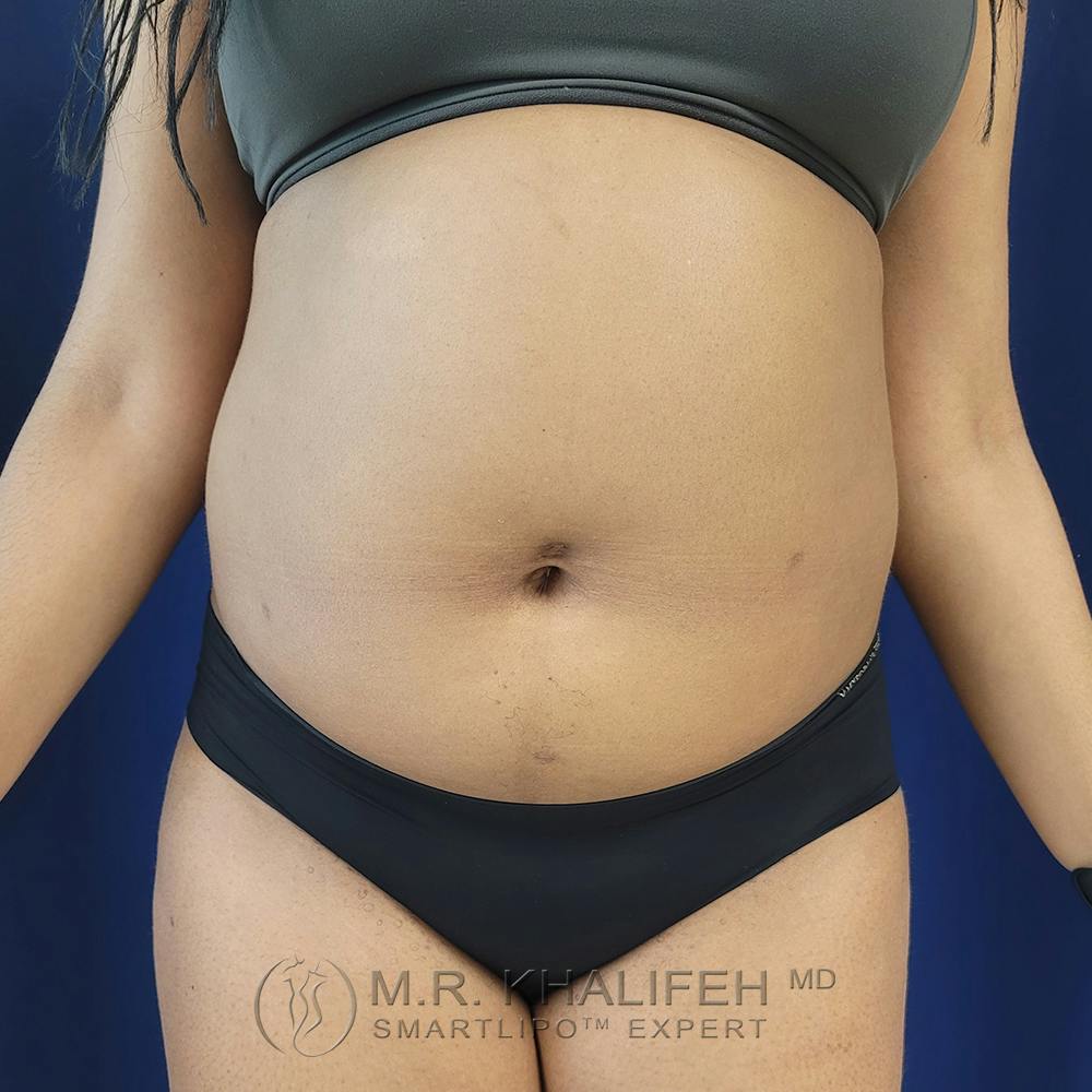 Abdominal Liposuction Gallery - Patient 122890617 - Image 1