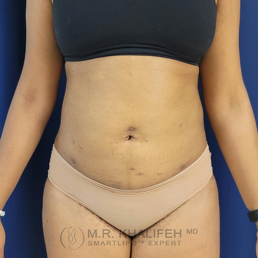 Abdominal Liposuction Gallery - Patient 122890617 - Image 2