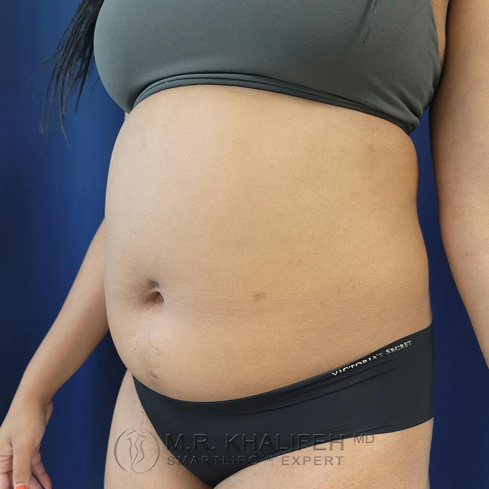 Abdominal Liposuction Gallery - Patient 122890617 - Image 7