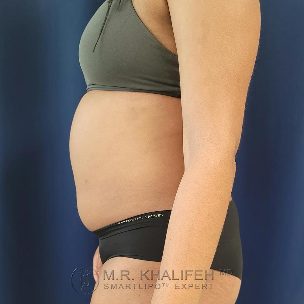 Abdominal Liposuction Gallery - Patient 122890617 - Image 9
