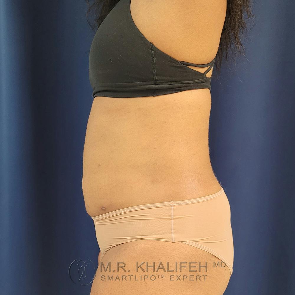 Abdominal Liposuction Gallery - Patient 122890617 - Image 10
