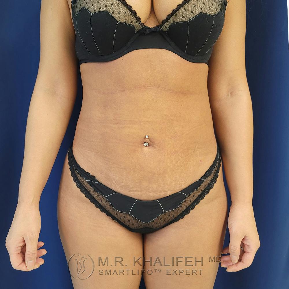 Abdominal Liposuction Gallery - Patient 122891125 - Image 2