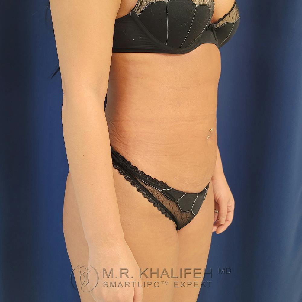 Abdominal Liposuction Gallery - Patient 122891125 - Image 12