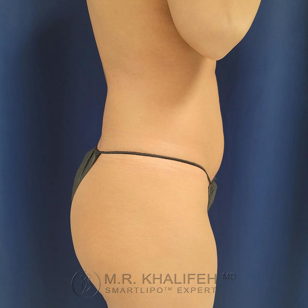 Abdominal Liposuction Gallery - Patient 122891125 - Image 9