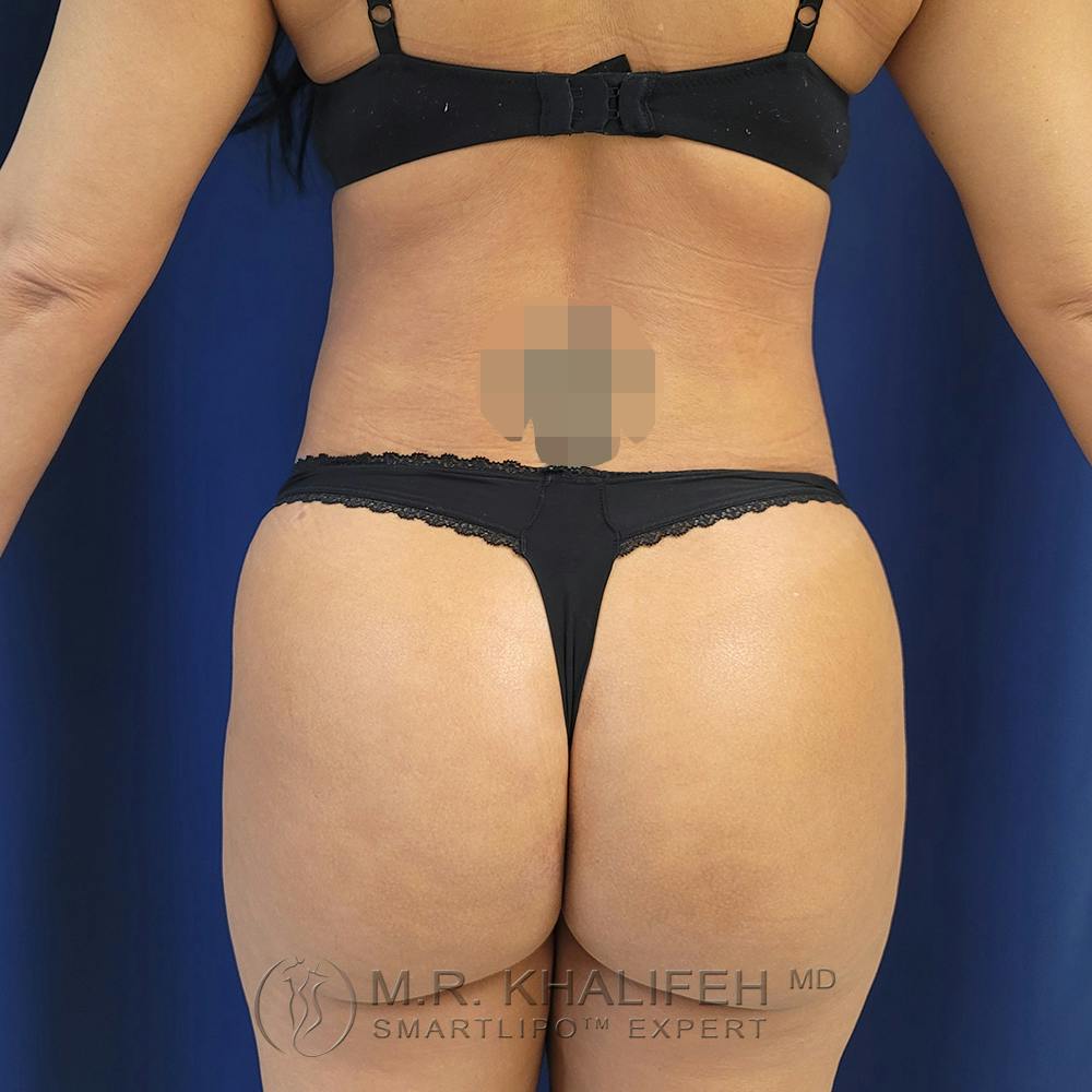 Flank-Lower Back Liposuction Gallery - Patient 122891122 - Image 2