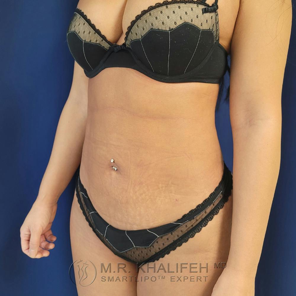 Abdominal Liposuction Gallery - Patient 122891125 - Image 4
