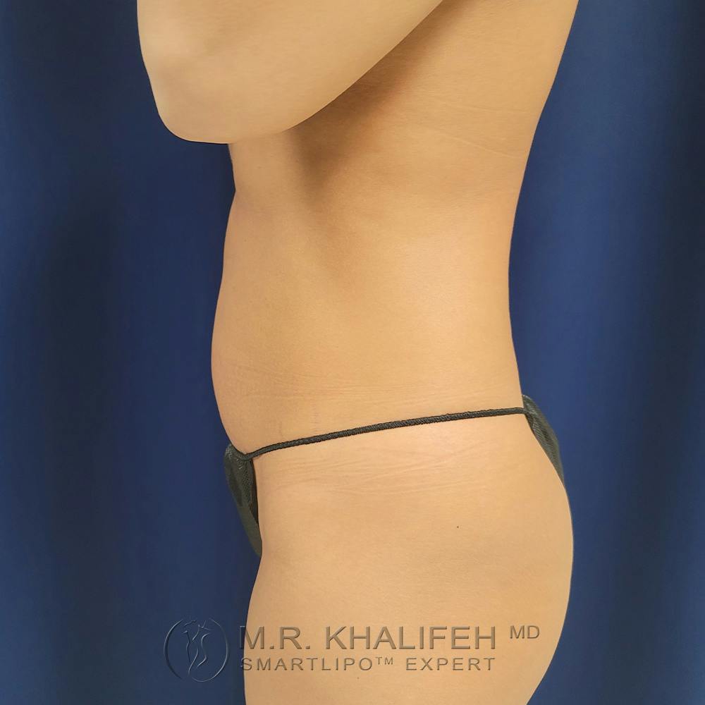 Abdominal Liposuction Gallery - Patient 122891125 - Image 5