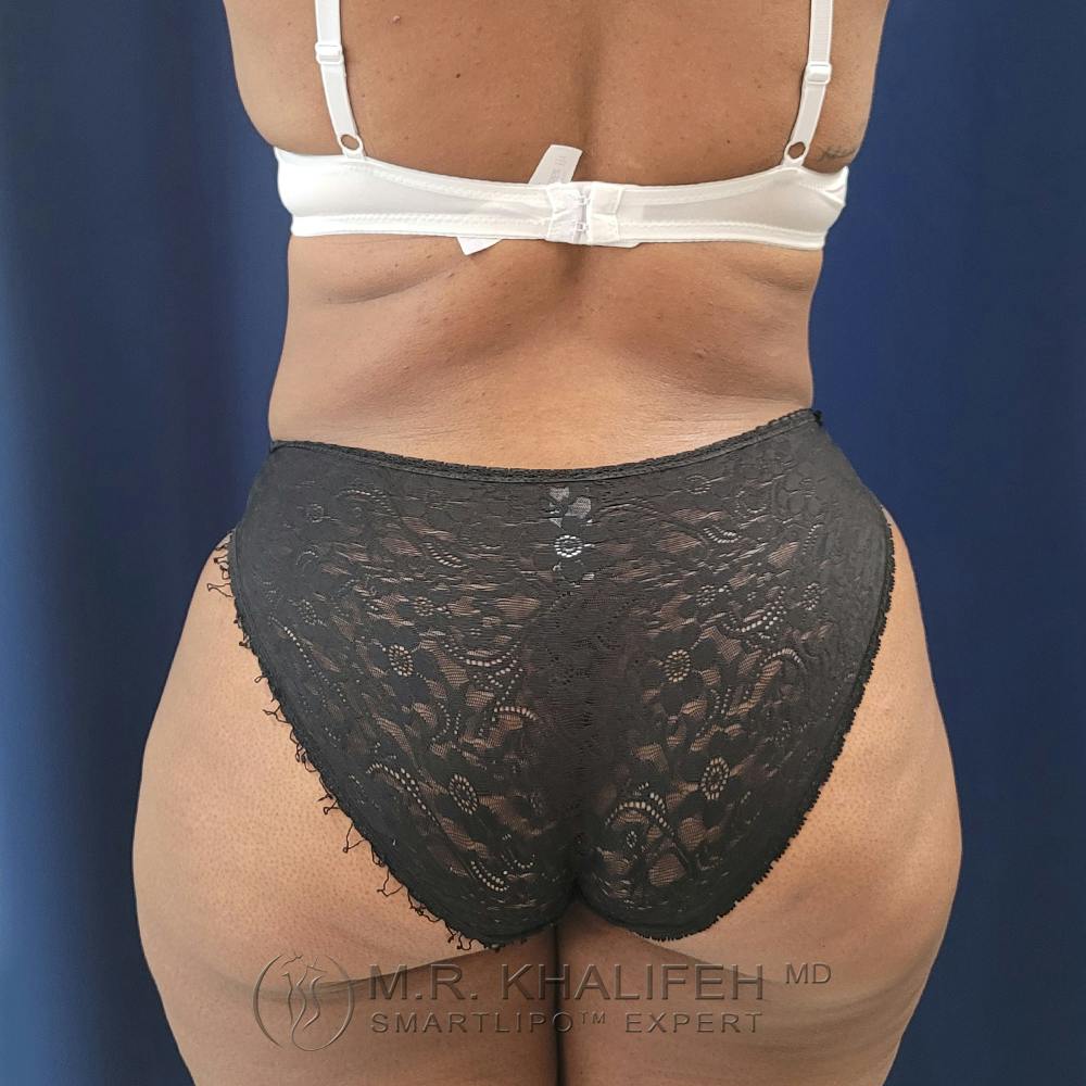 Flank-Lower Back Liposuction Gallery - Patient 122975152 - Image 2