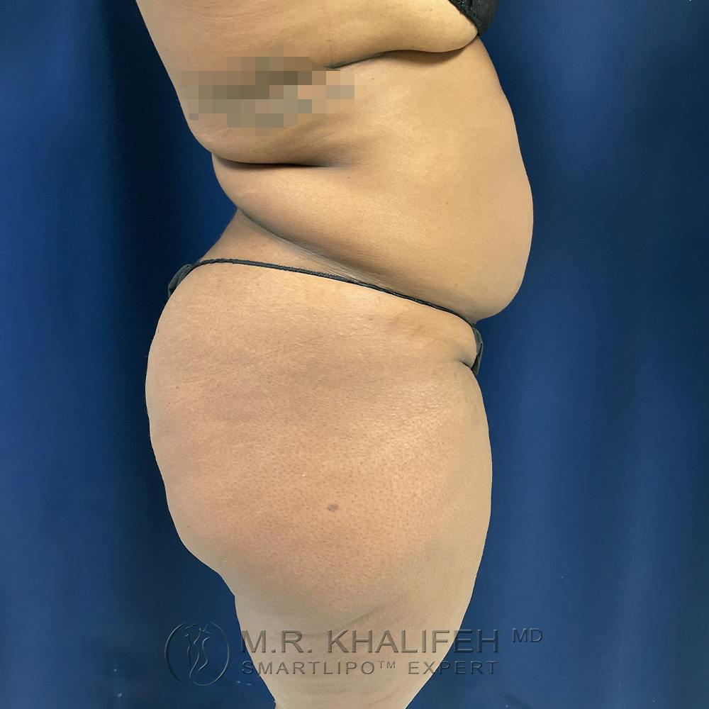 Flank-Lower Back Liposuction Gallery - Patient 122975152 - Image 3