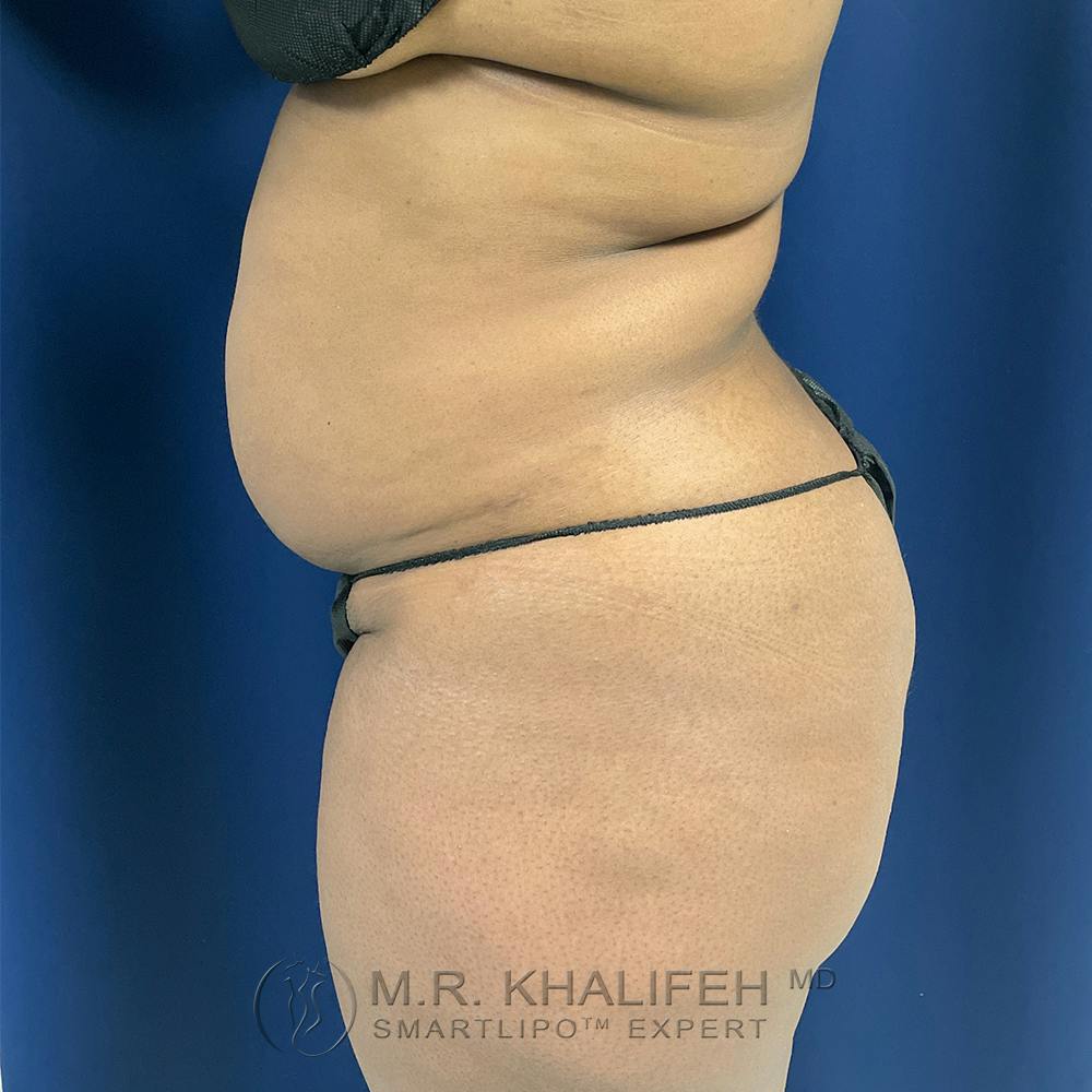 Flank-Lower Back Liposuction Gallery - Patient 122975152 - Image 5
