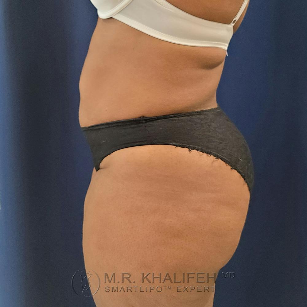 Flank-Lower Back Liposuction Gallery - Patient 122975152 - Image 6