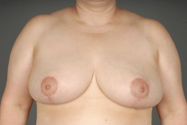 Breast Reduction Before & After Gallery - Patient 3689091 - Image 2