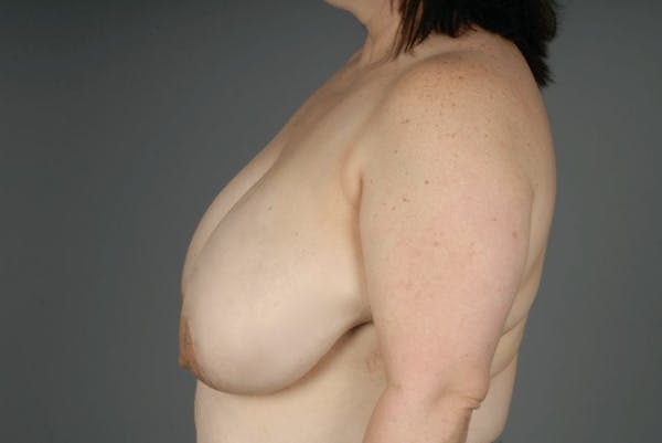 Breast Reduction Before & After Gallery - Patient 3689091 - Image 7