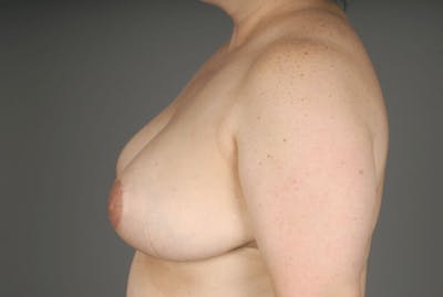 Breast Reduction Before & After Gallery - Patient 3689091 - Image 8