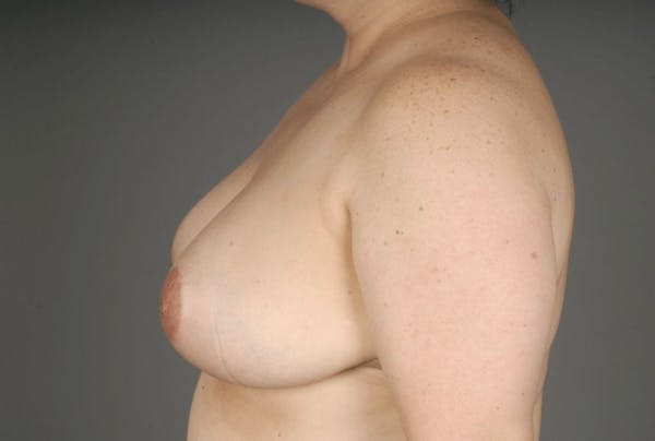 Breast Reduction Before & After Gallery - Patient 3689091 - Image 8