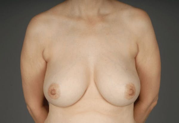 Breast Reduction Before & After Gallery - Patient 3689092 - Image 1