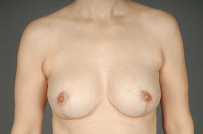 Breast Reduction Before & After Gallery - Patient 3689092 - Image 2