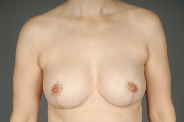 Breast Reduction Before & After Gallery - Patient 3689092 - Image 2