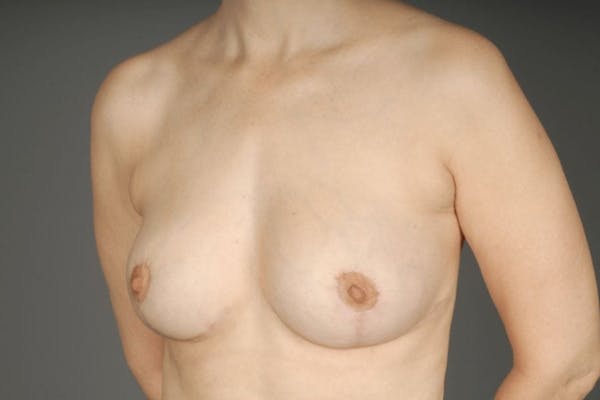 Breast Reduction Before & After Gallery - Patient 3689092 - Image 4