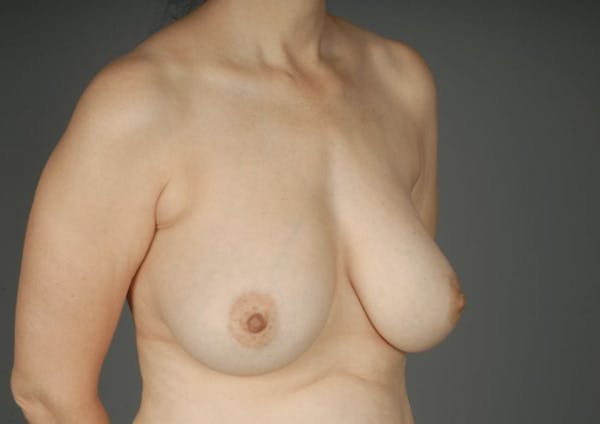 Breast Reduction Before & After Gallery - Patient 3689092 - Image 5