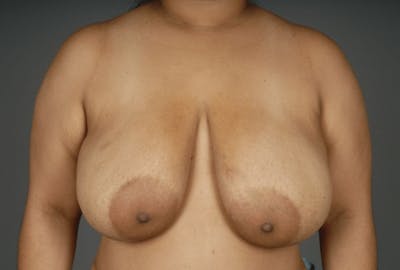 Breast Reduction Before & After Gallery - Patient 3689093 - Image 1
