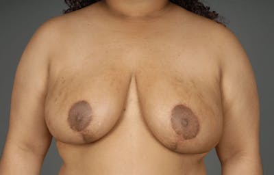 Breast Reduction Before & After Gallery - Patient 3689093 - Image 2