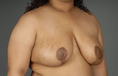 Breast Reduction Before & After Gallery - Patient 3689093 - Image 6