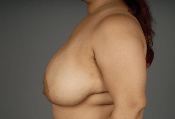 Breast Reduction Before & After Gallery - Patient 3689093 - Image 7