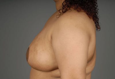Breast Reduction Before & After Gallery - Patient 3689093 - Image 8