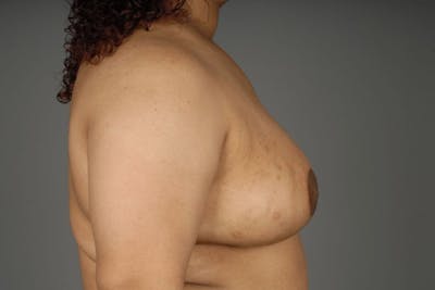 Breast Reduction Before & After Gallery - Patient 3689093 - Image 10
