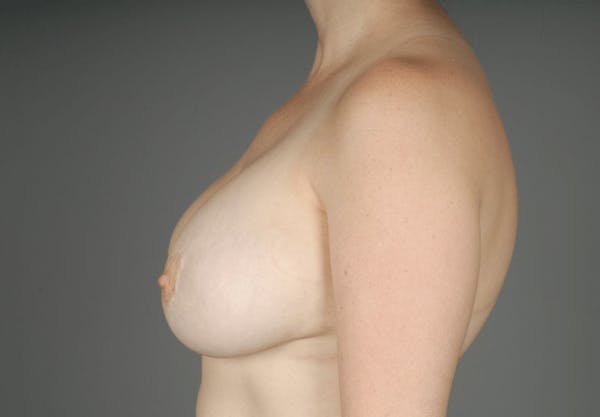 Implant Removal + Lift Before & After Gallery - Patient 3689097 - Image 7