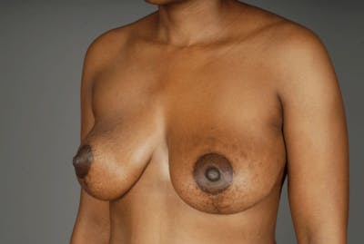 Mommy Makeover Before & After Gallery - Patient 3689101 - Image 4