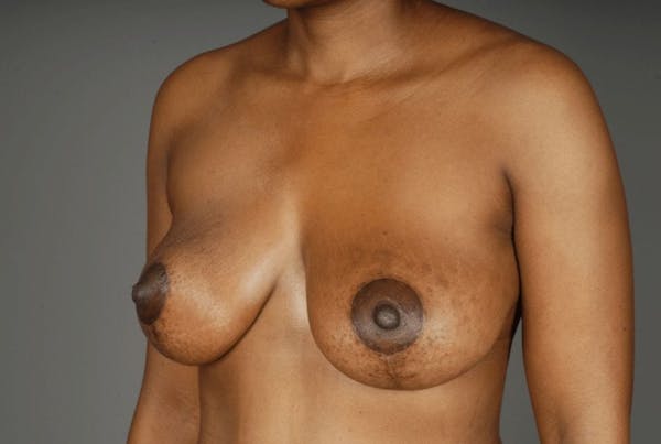 Mommy Makeover Before & After Gallery - Patient 3689101 - Image 4