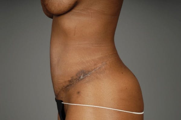 Mommy Makeover Before & After Gallery - Patient 3689101 - Image 18