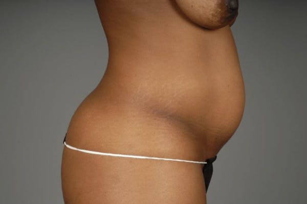 Mommy Makeover Before & After Gallery - Patient 3689101 - Image 19