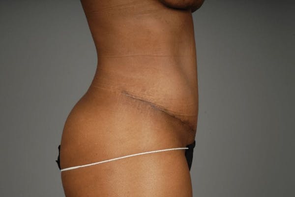 Mommy Makeover Before & After Gallery - Patient 3689101 - Image 20