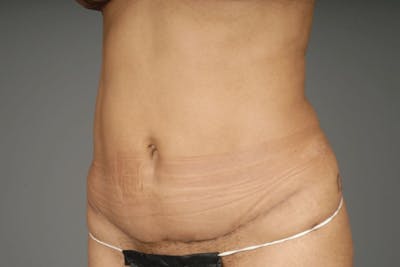 Mommy Makeover Before & After Gallery - Patient 3689102 - Image 16