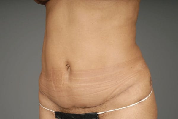 Mommy Makeover Before & After Gallery - Patient 3689102 - Image 16