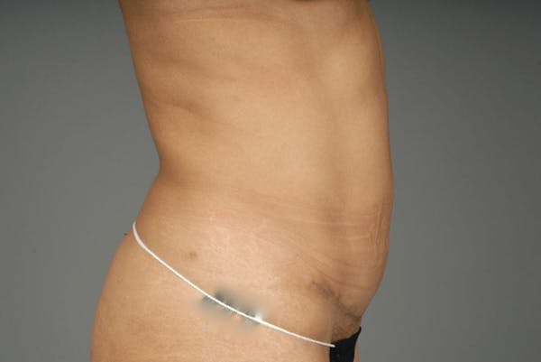 Mommy Makeover Before & After Gallery - Patient 3689102 - Image 24